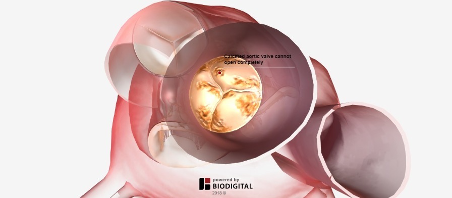 3D Tour of Aortic Valve Stenosis