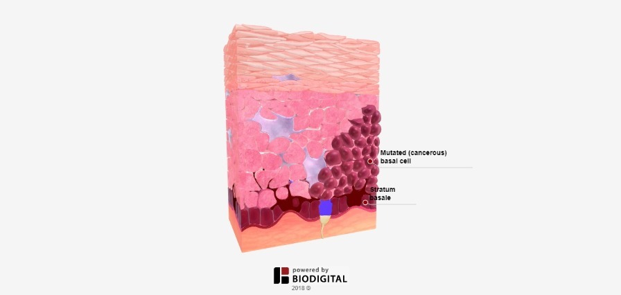 3D Tour of Basal Cell Carcinoma in Tissue