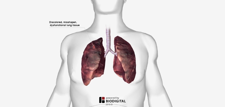3D Tour of Complications from Smoking