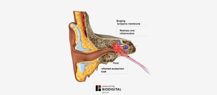 3D Tour of Middle Ear Infection