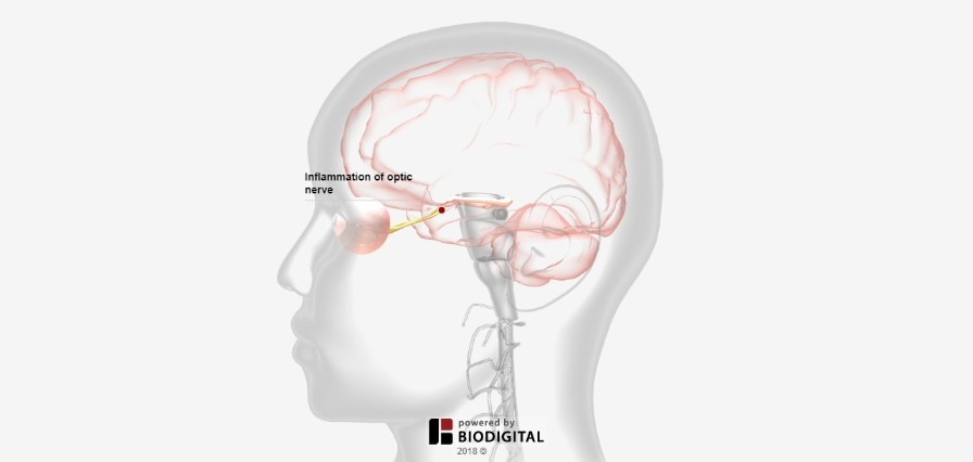 3D Tour of Optic Neuritis