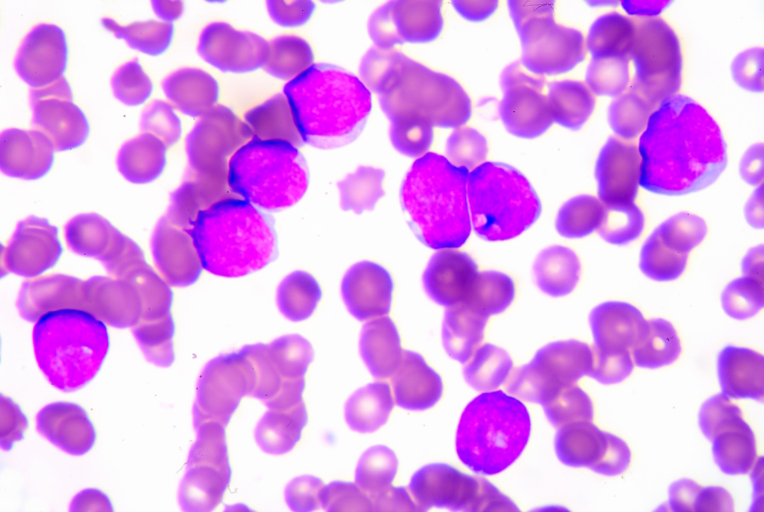 EVALUATING ANEMIA